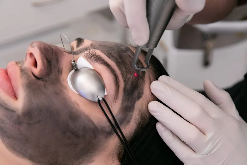 Carbon layer applied to the face before a laser pass at Anima Med Spa