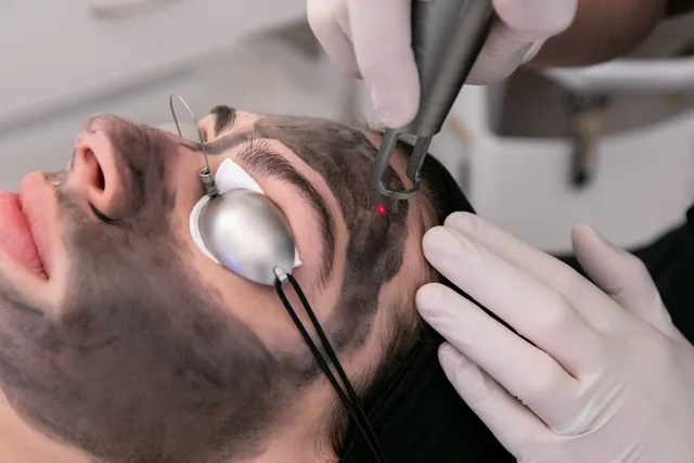 Carbon layer applied to the face before a laser pass at Anima Med Spa