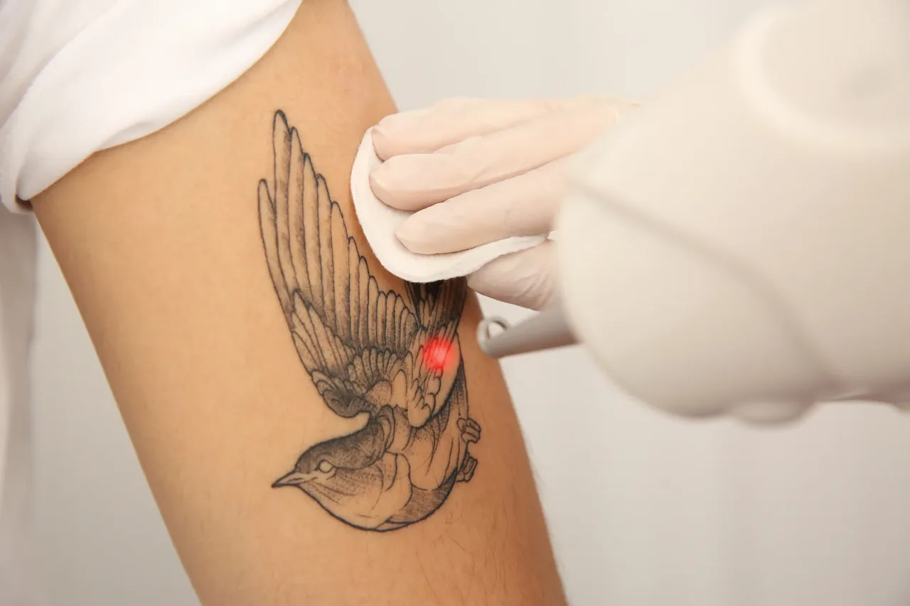 Laser tattoo removal imagery published by Anima Med Spa