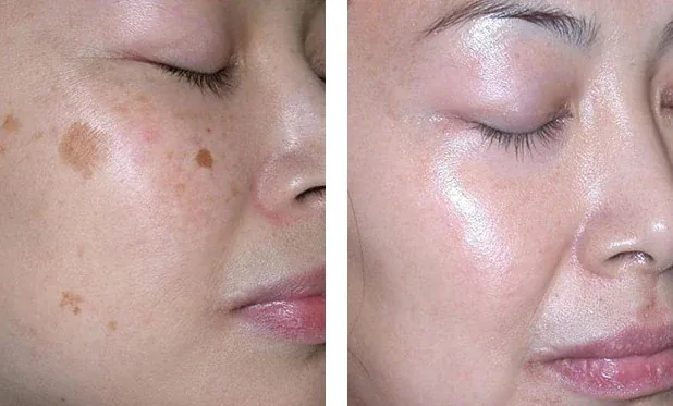 Laser pigment removal imagery published by Anima Med Spa