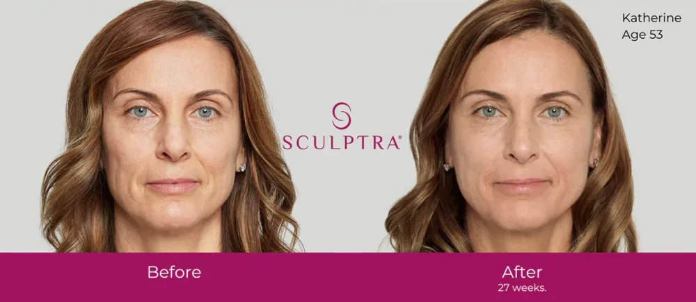 Sculptra treatment imagery published by Anima Med Spa